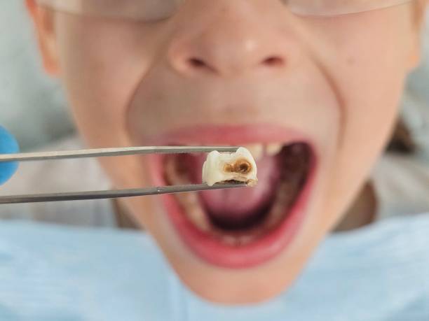 Best Emergency Wisdom Teeth Removal in Napoleon, OH