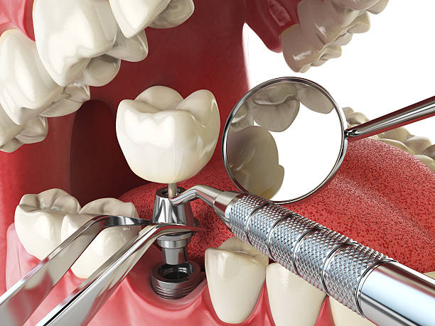 Best Emergency Tooth Extraction in Napoleon, OH